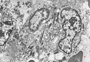 bone marrow - crystalloid inclusions Charcot-Leyden crystals formation v.s. bone marrow - crystalloid inclusions Charcot-Leyden crystals formation v.s.